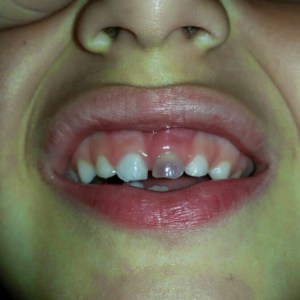 diente negro