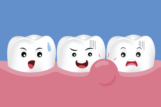 ¡Alerta Encías! Descubre qué es la enfermedad periodontal y cómo prevenirla
