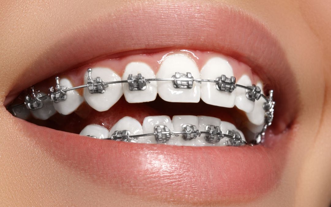 Alinear los dientes con el tratamiento de ortodoncia