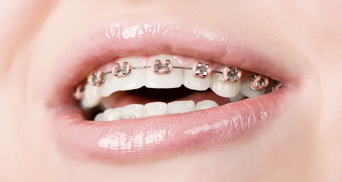 Lo que (quizá) no sabías sobre la ortodoncia